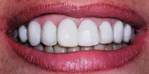 Caso real de carillas de composite, un tratamiento de estética dental muy eficaz