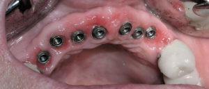 Caso real de pérdida de varios dientes antes del tratamiento