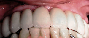 Caso real de pérdida de varios dientes después del tratamiento