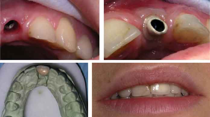 Tratamiento de un caso real de pérdida de un diente