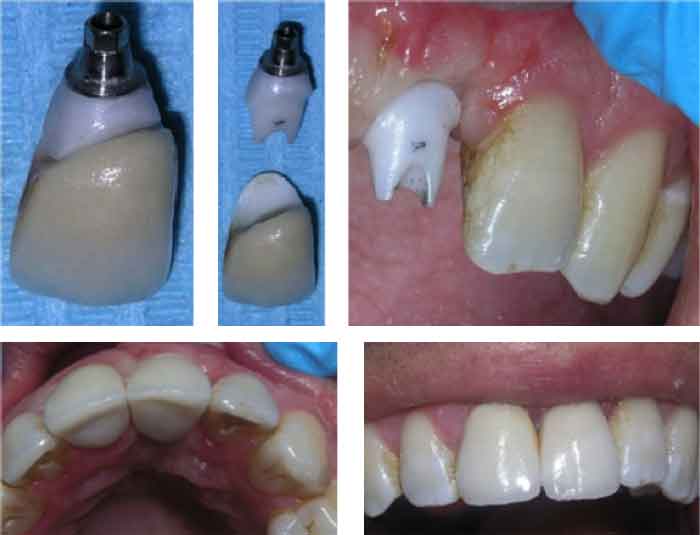 Tienda traición clase corona-zirconio-cementada-sobre-pilar-zirconio-atornillado-implante-700x535  - Clínica Dental Gaudí