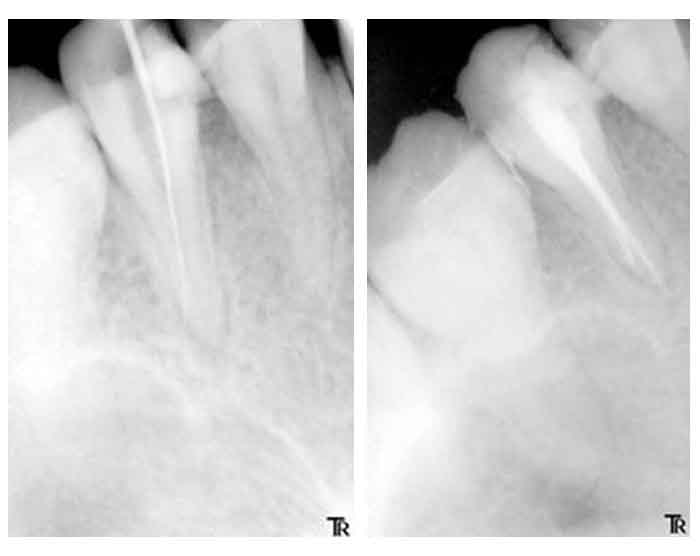 Caso real de un tratamiento de endodoncia