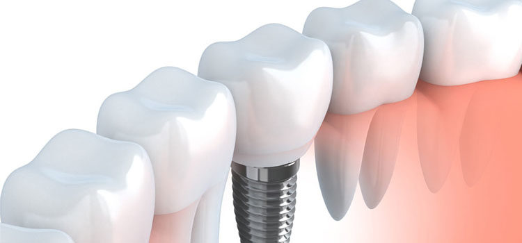 7 preguntas y respuestas sobre los implantes dentales