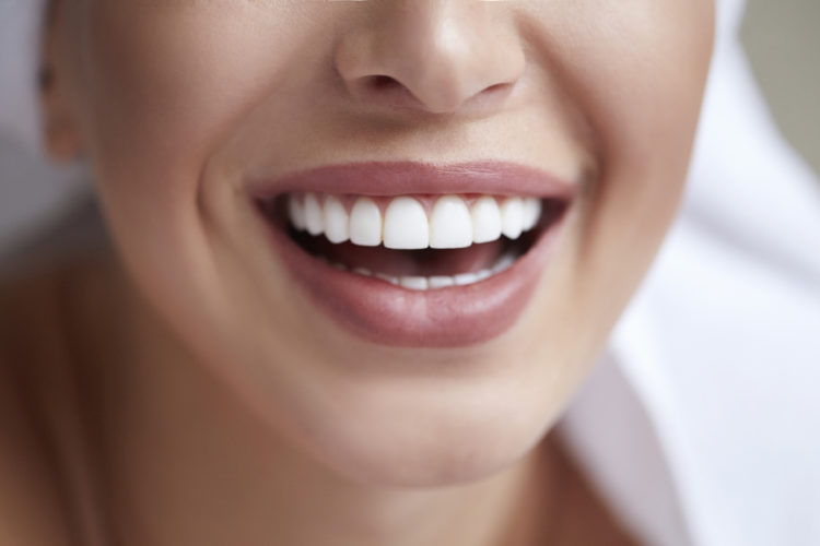 Carillas dentales