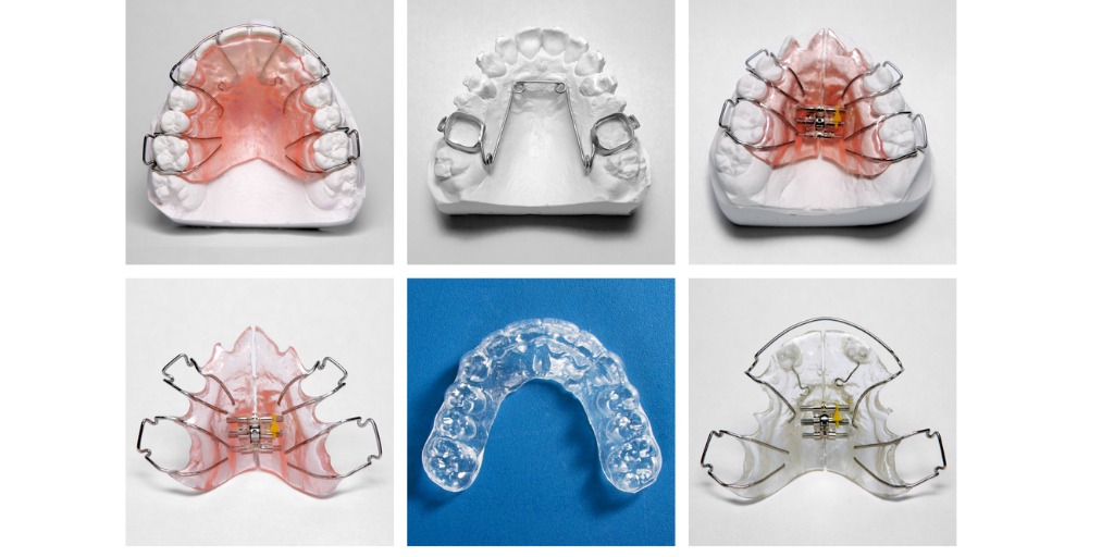 vendaje Potencial Mal Por qué es necesario el uso de retenedores después de un tratamiento de  Ortodoncia? - Clínica Dental Gaudí