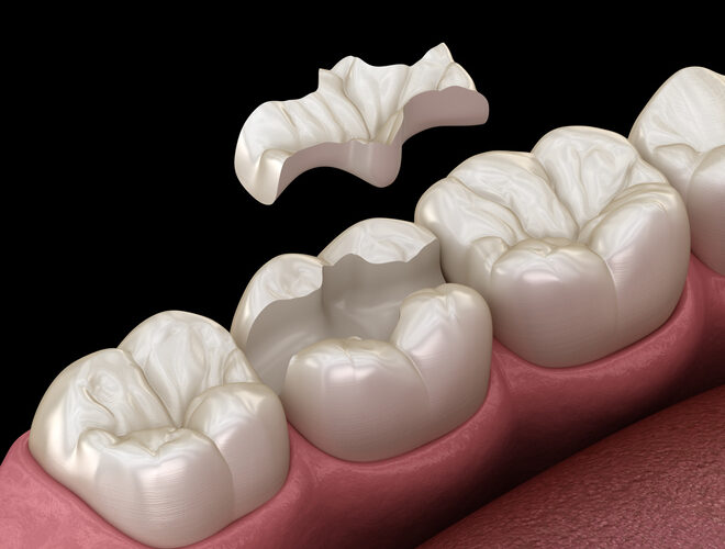 incrustación dental