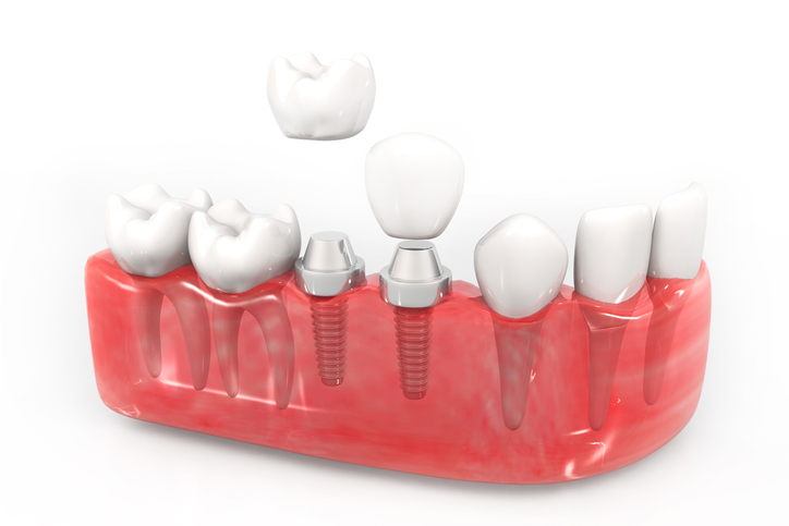 implantes prótesis dentales