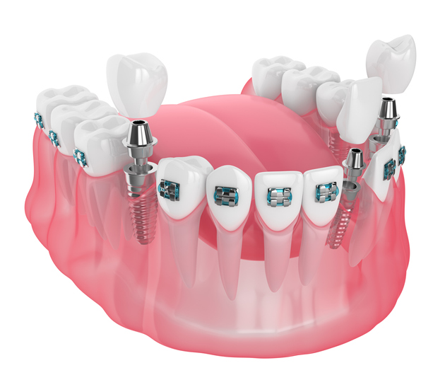 ¿Cuáles son los riesgos de los implantes dentales?