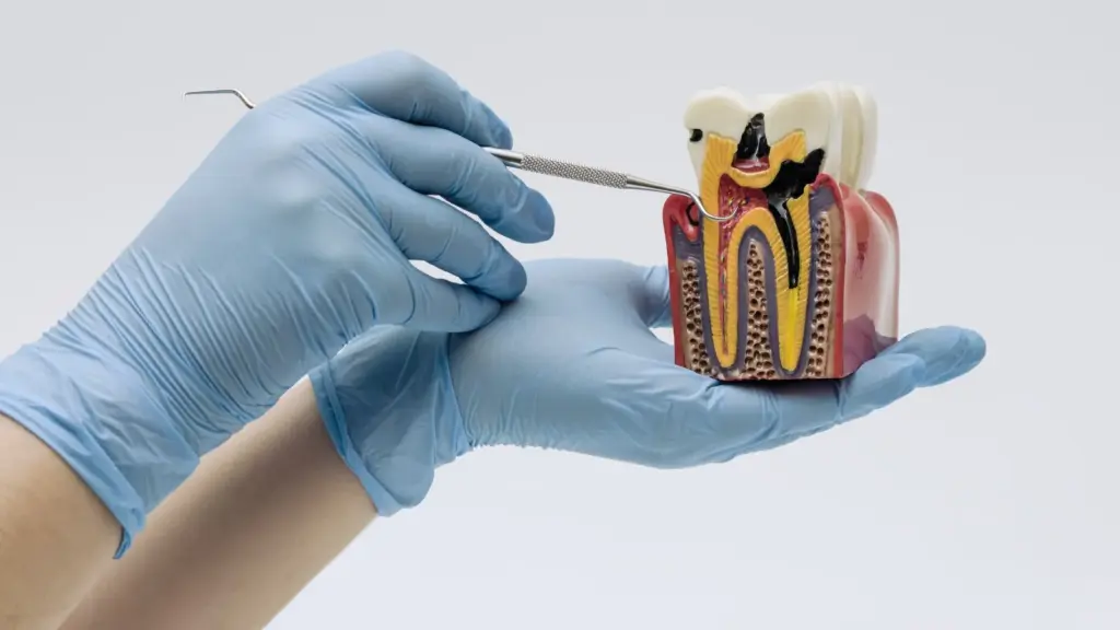 Tipos de caries vamos de la más leve a la más grave y te contamos cuándo conviene tratarlas.