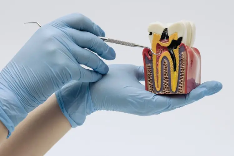 Tipos de caries vamos de la más leve a la más grave y te contamos cuándo conviene tratarlas.