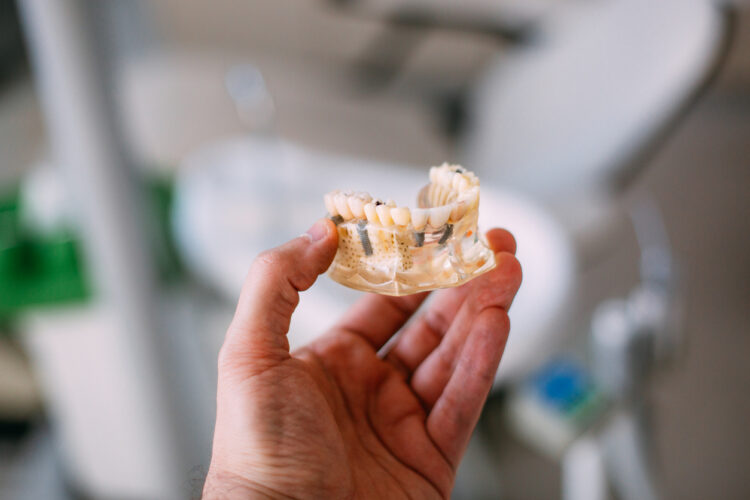 duración de los implantes dentales